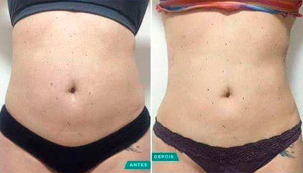 Antes e depois - 7 dias